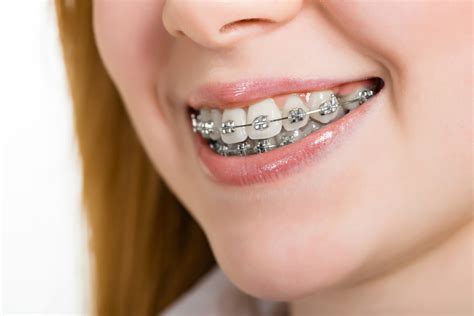 diferentes tipos de brackets metalicos|brackets metalicos.